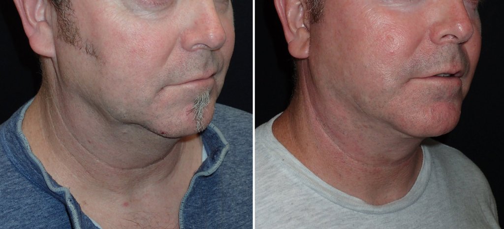 Facelifts for Men in Richmond