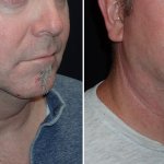Facelifts for Men in Richmond