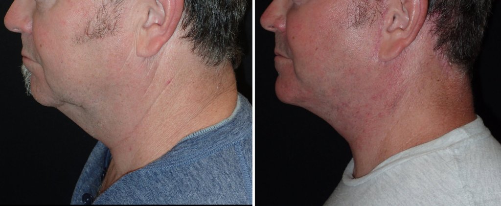 Facelifts for Men in Richmond