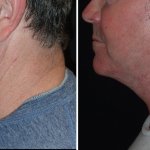 Facelifts for Men in Richmond