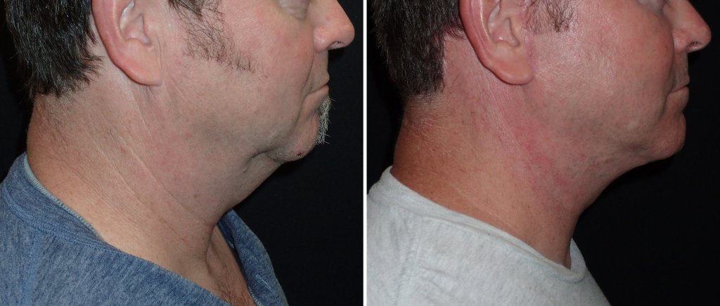 Facelifts for Men in Richmond