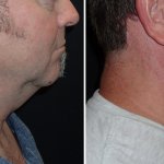 Facelifts for Men in Richmond