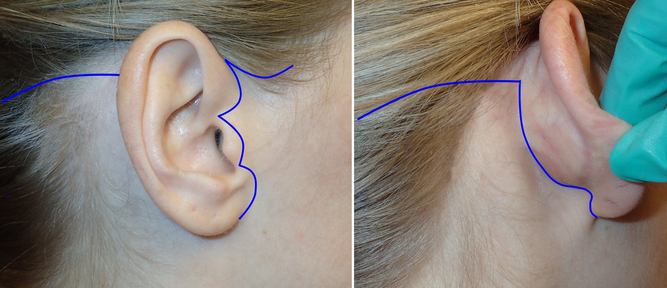 Facelift Incisions Scars Richmond VA Hidden Facelift Scars