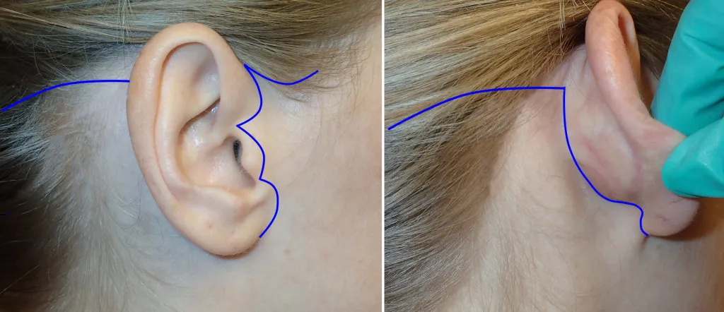 standard facelift incisions in front of and behind the ear