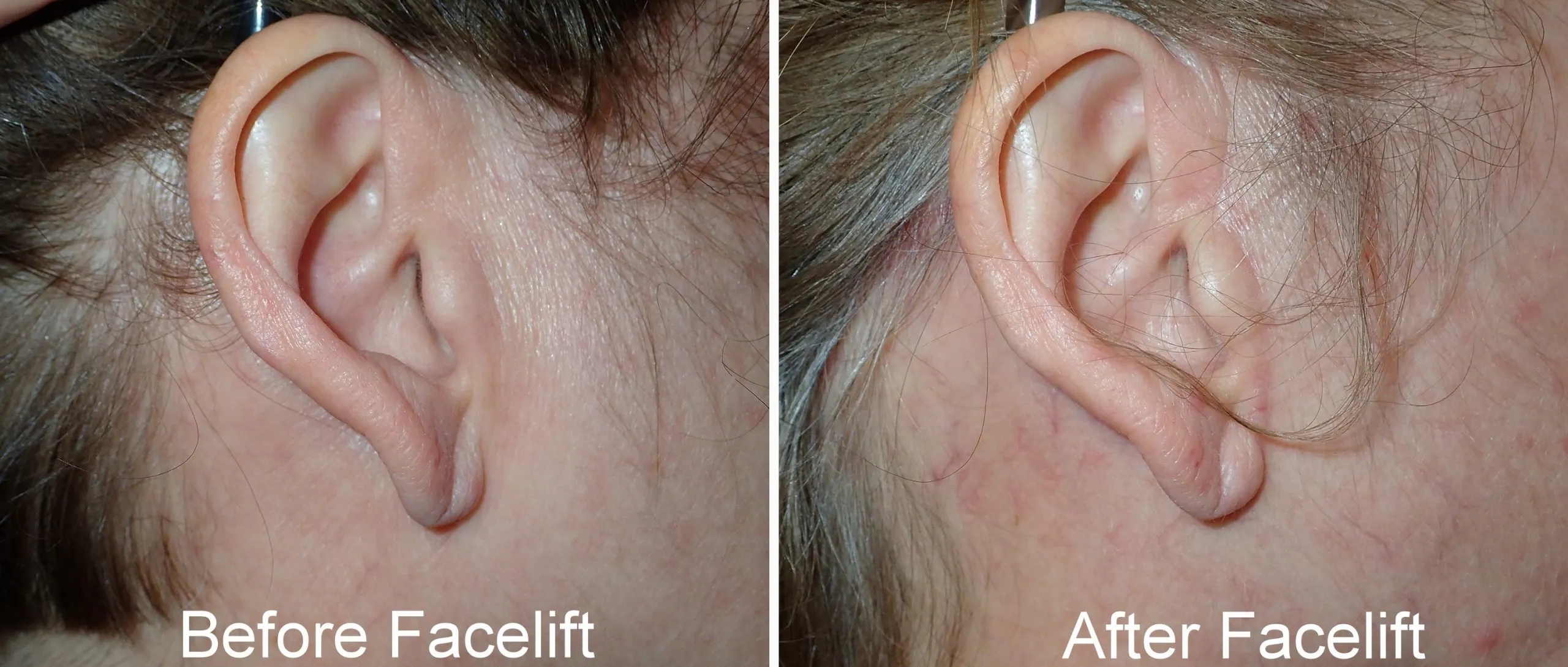 before and after pictures of typical facelift incisions performed by Dr. Niamtu