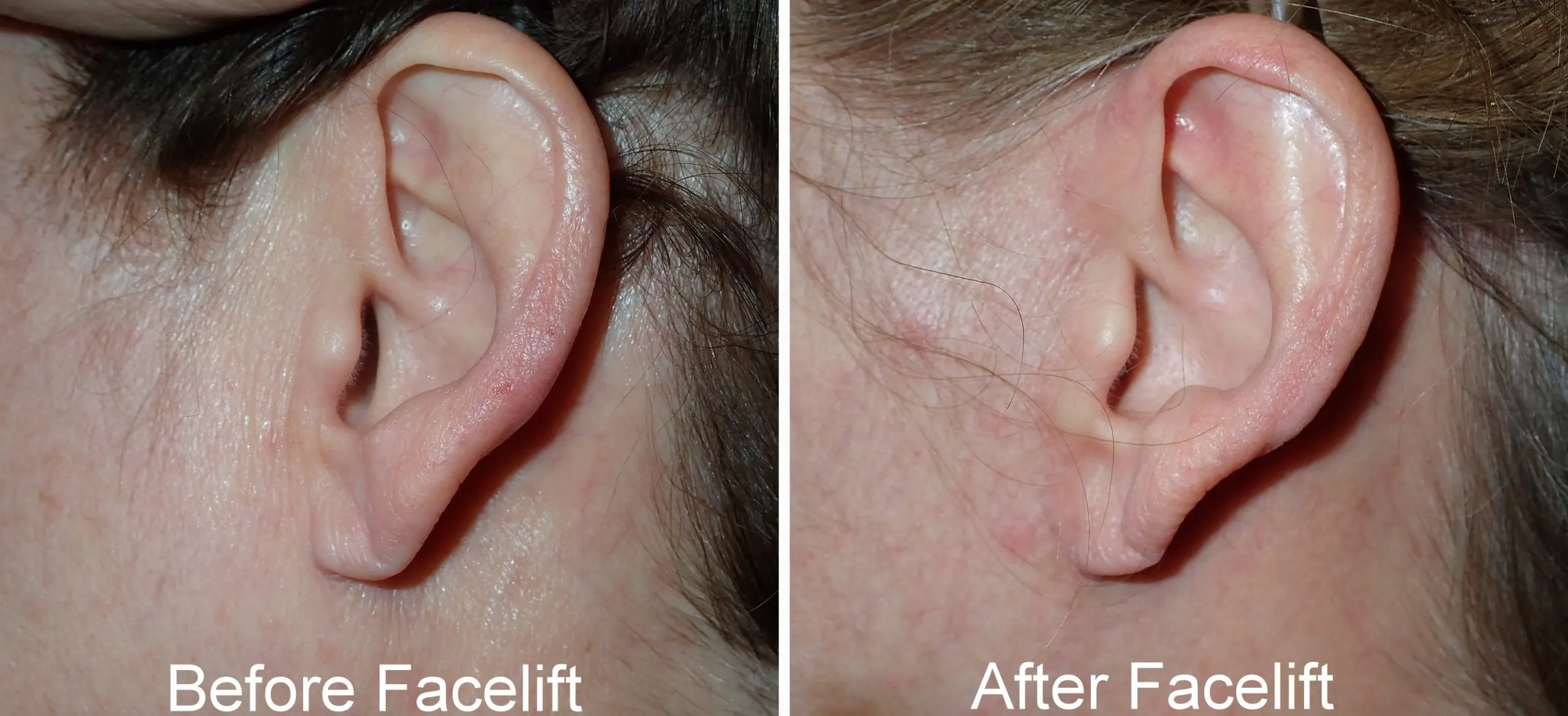 before and after pictures of typical facelift incisions performed by Dr. Niamtu