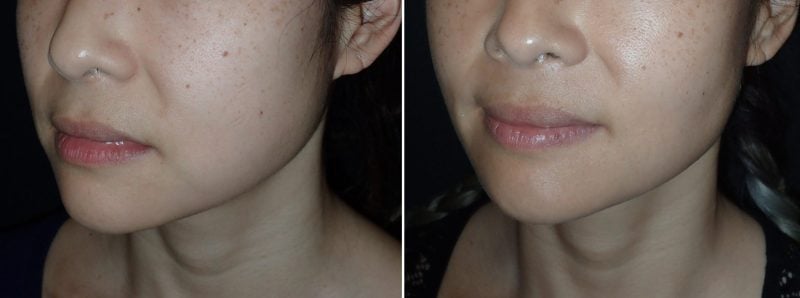 Buccal Fat Pad Reduction