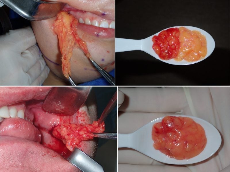 Buccal Fat Pad Reduction