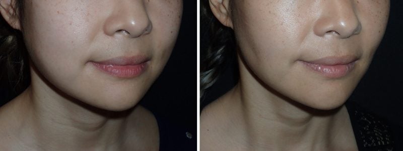 Buccal Fat Pad Reduction