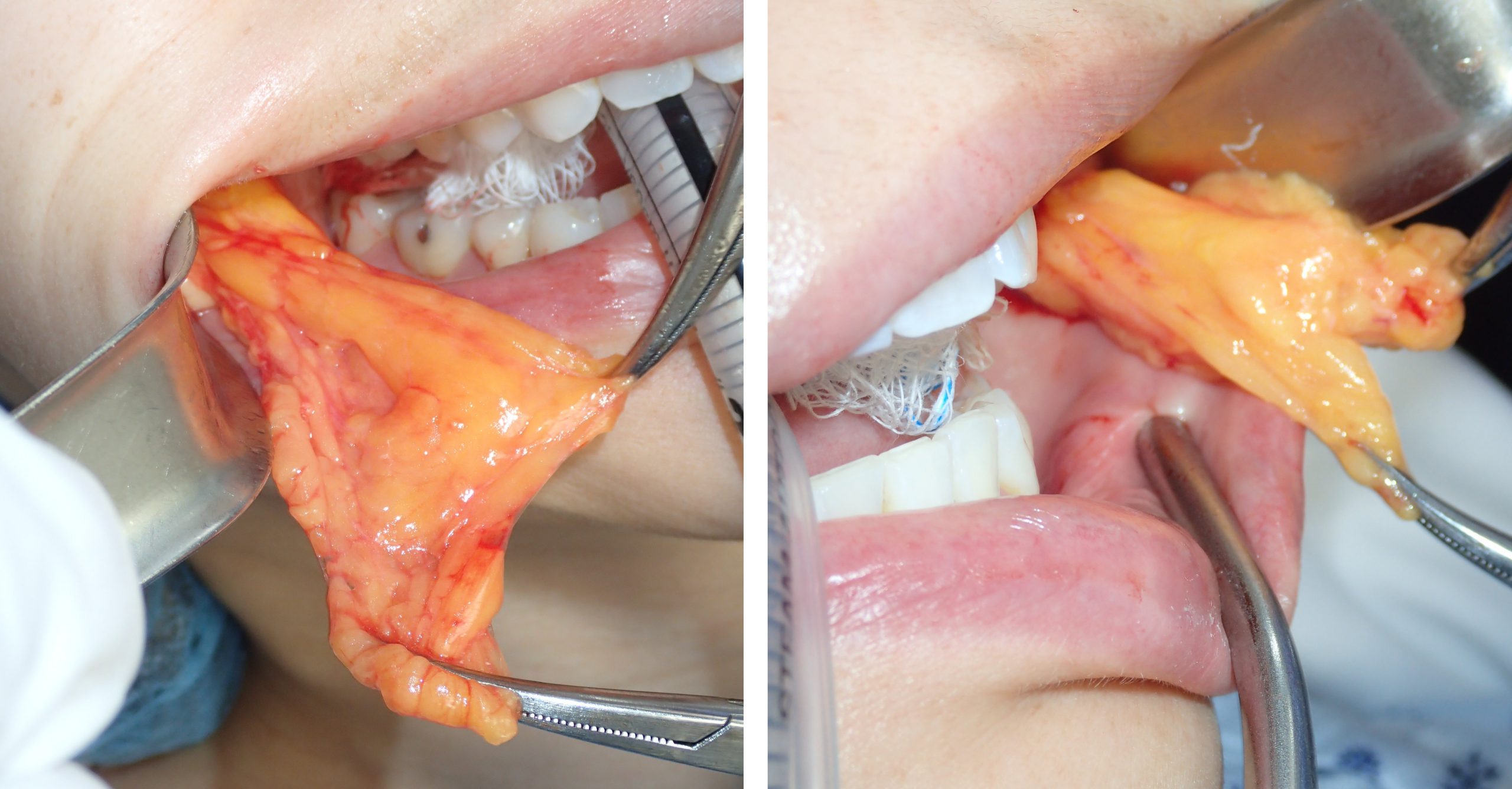 Submentoplasty