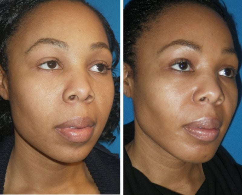 Buccal Fat Pad Reduction