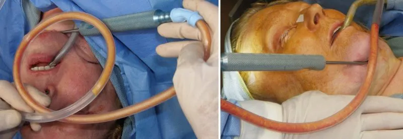 Face and Neck Liposuction