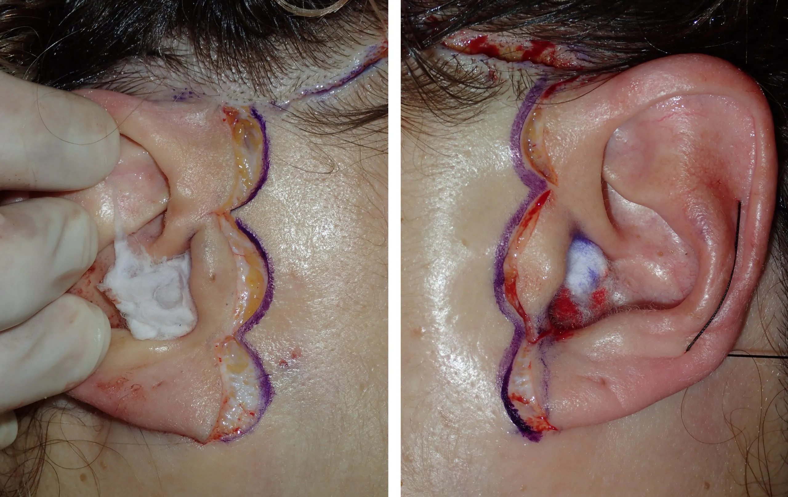 standard facelift incisions in front of and behind the ear
