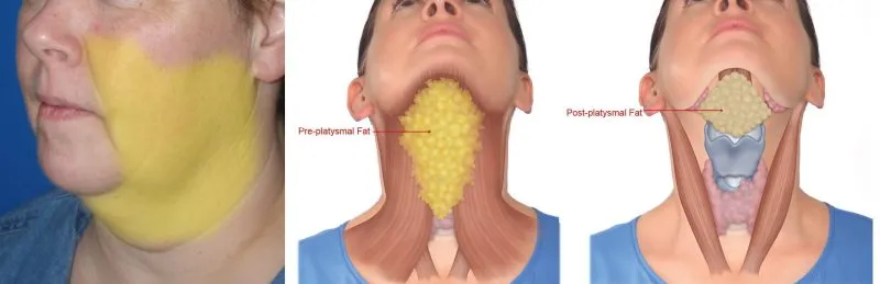 Face and Neck Liposuction