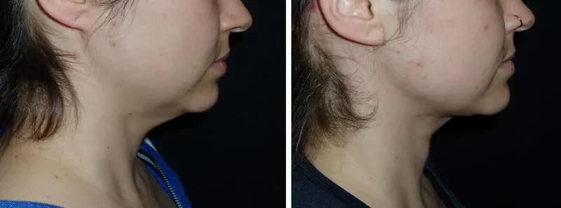 up close photo of a chin