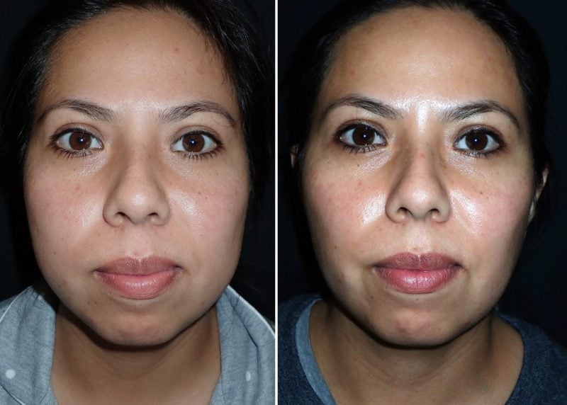 Buccal Fat Pad Reduction