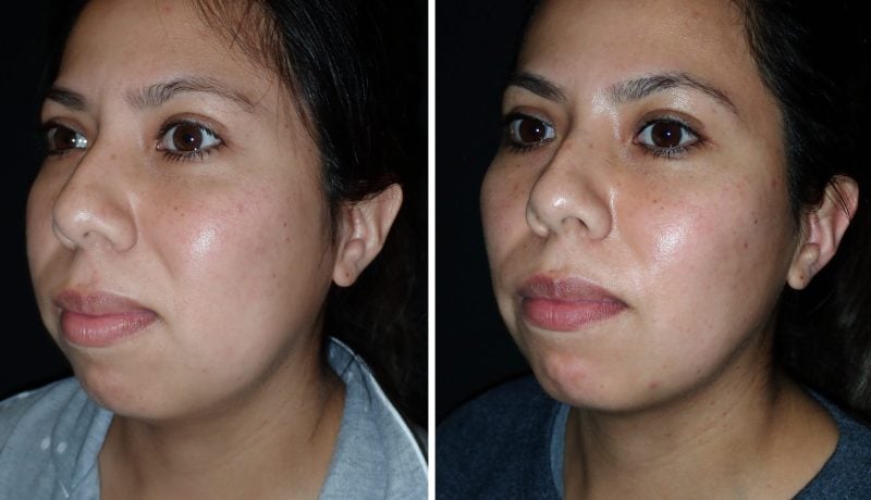 buccal fat reduction