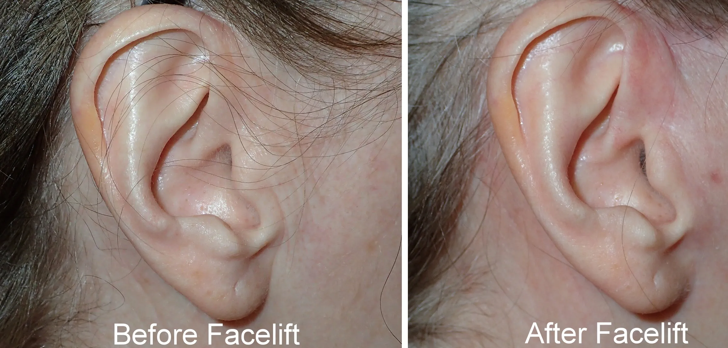 before and after pictures of typical facelift incisions performed by Dr. Niamtu