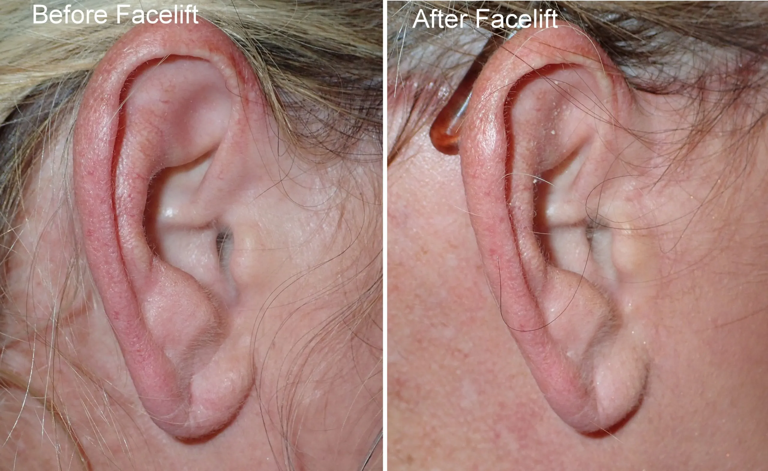 before and after pictures of typical facelift incisions performed by Dr. Niamtu