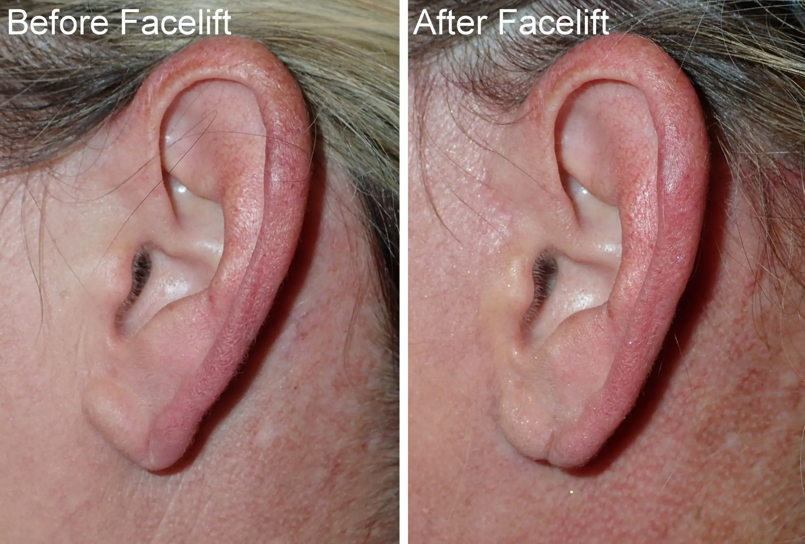 before and after pictures of typical facelift incisions performed by Dr. Niamtu