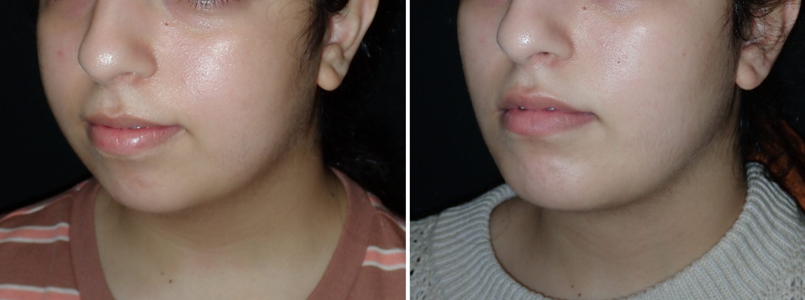 Submentoplasty in Richmond
