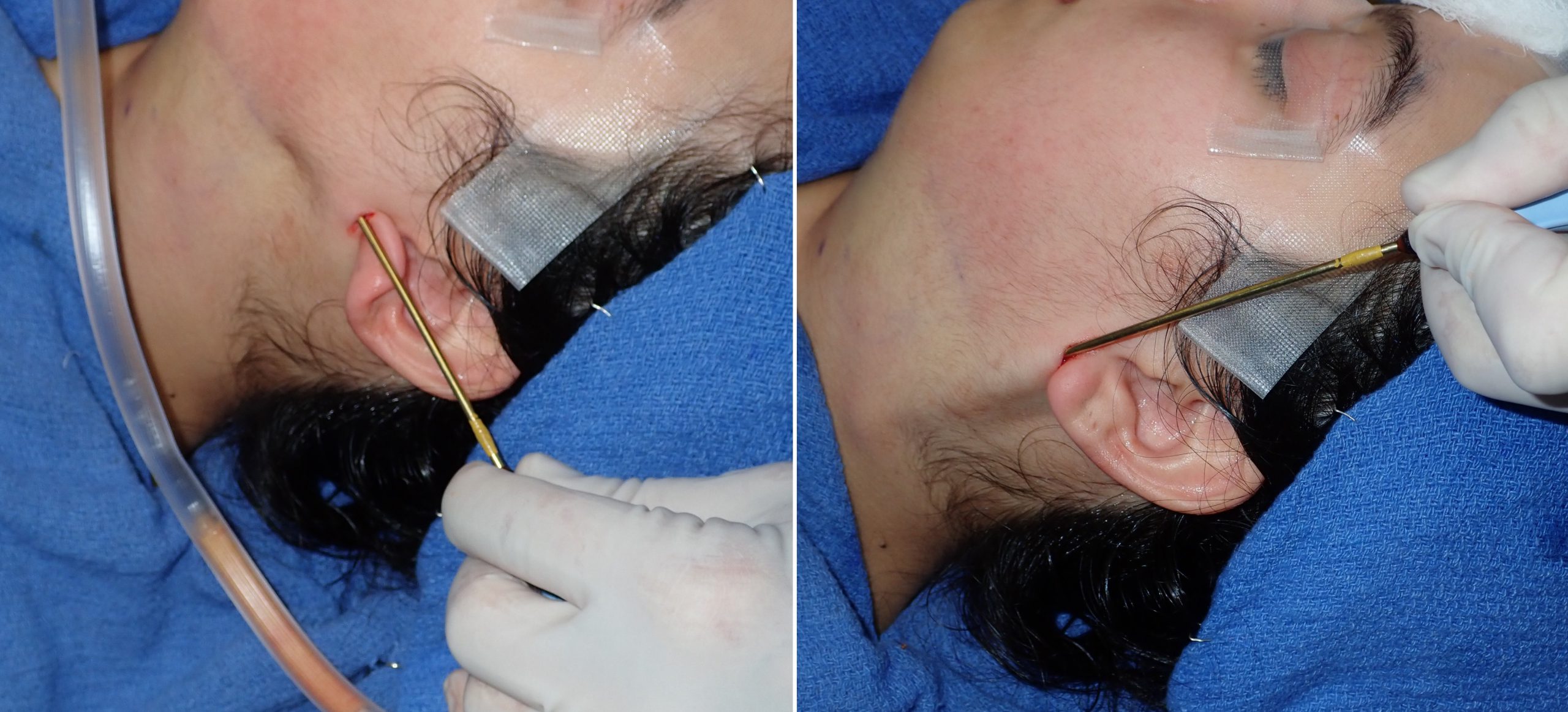Submentoplasty