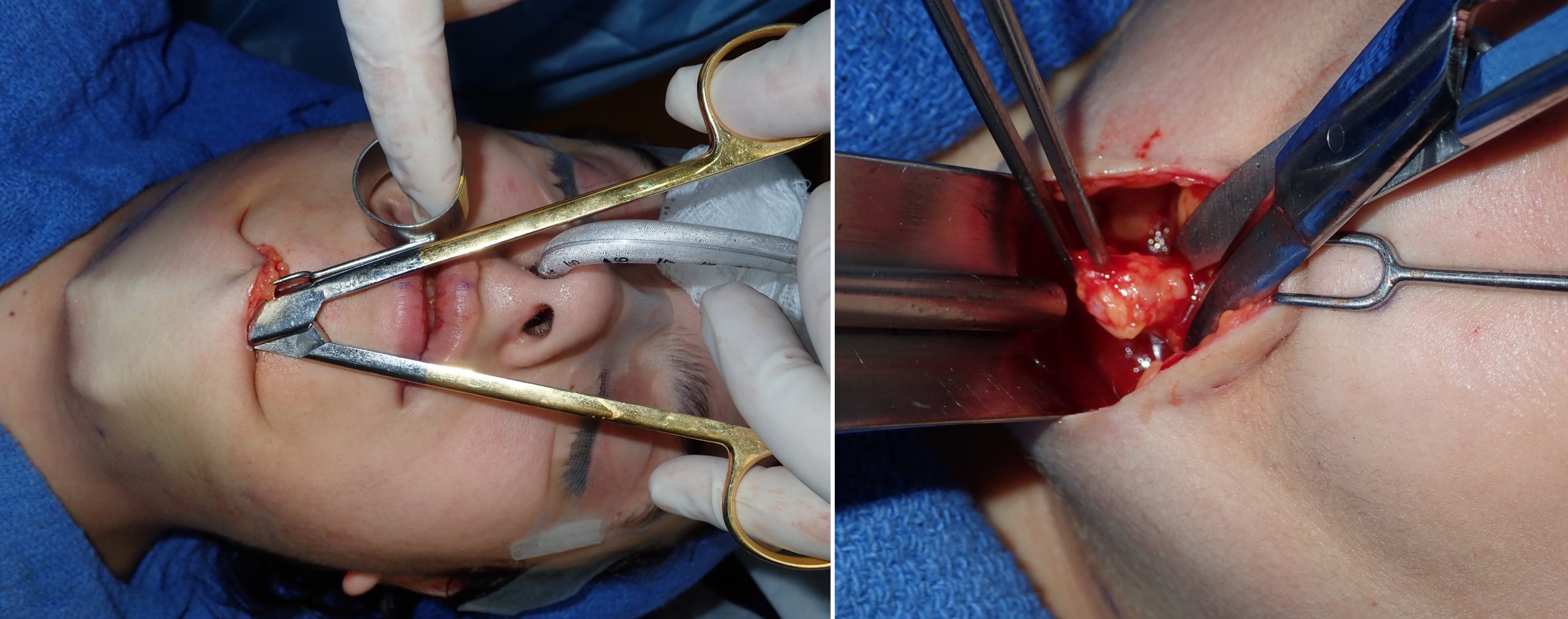 Submentoplasty