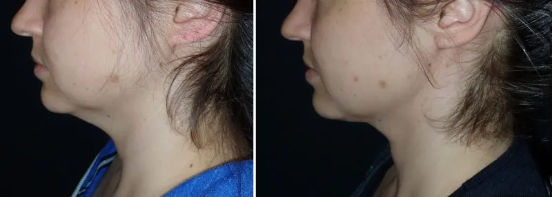 up close photo of a chin