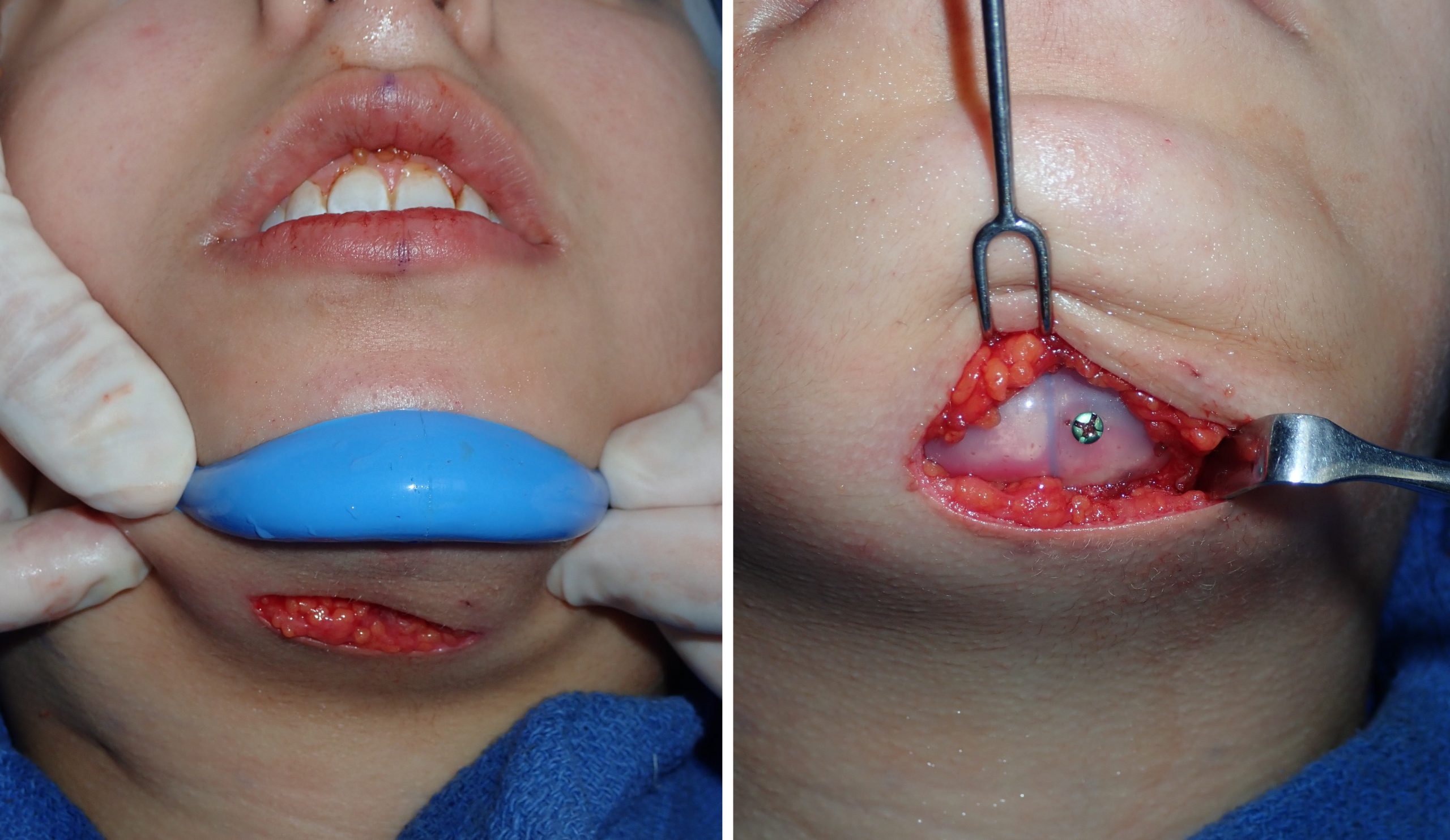 Submentoplasty
