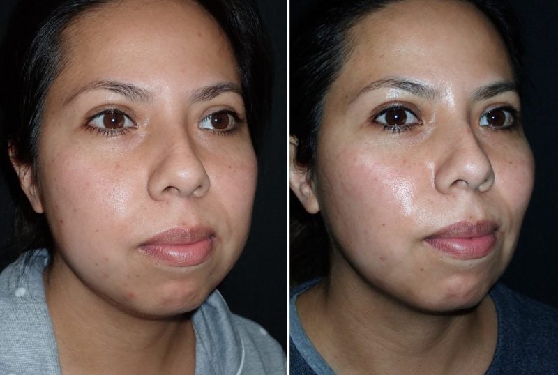 buccal fat reduction