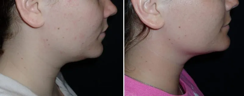 Face and Neck Liposuction