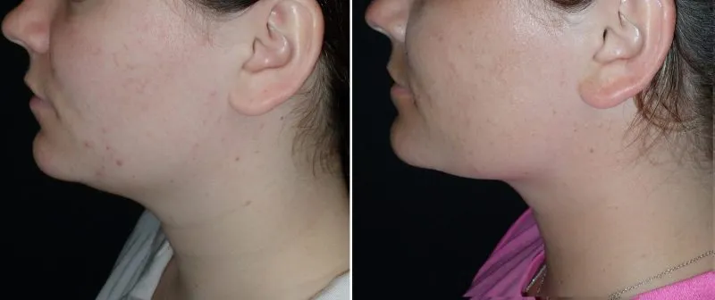 Face and Neck Liposuction