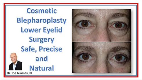 Lower Eyelid Blepharoplasty Important Facts You Need to Know