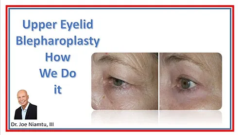Upper Eyelid Blepharoplasty