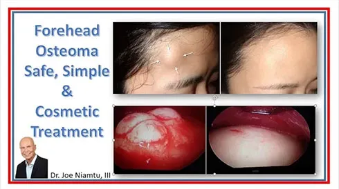 Forehead Osteoma Removal: Safe, Simple, and Cosmetic Results