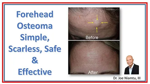 Forehead Osteoma Removal: Simple, Safe, Scarless & Effective