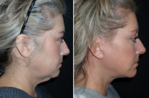 Deep Plane Facelift Richmond