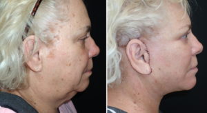 Deep Plane Facelift Richmond
