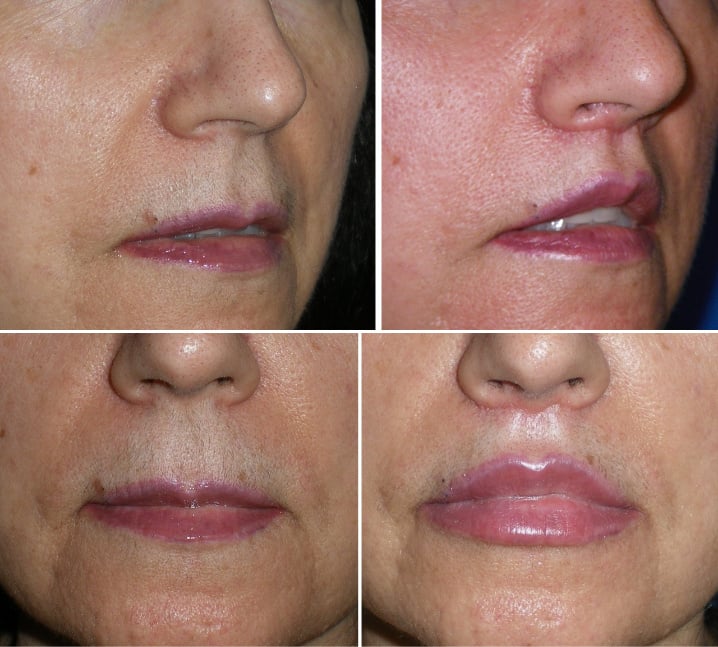 Before and after Lip Lift with Injectable Fillers Richmond VA