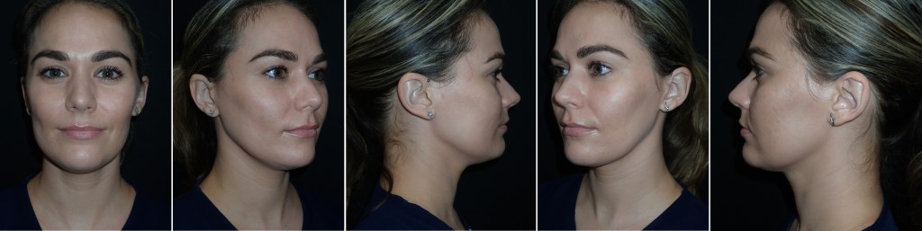 Cosmetic Facial Consultation in Richmond, VA Metro