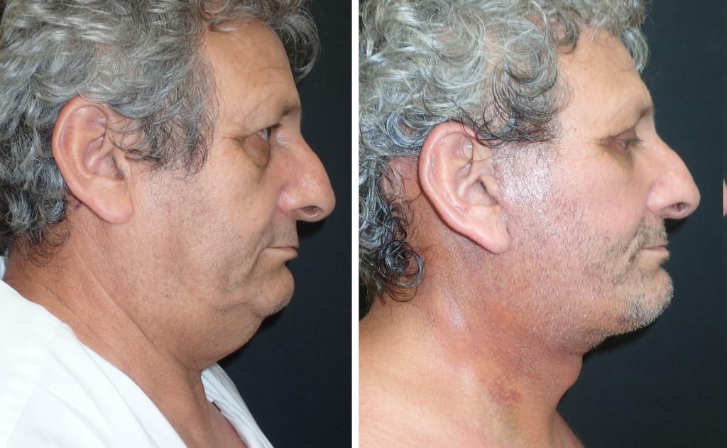 Facelifts for Men in Richmond, VA