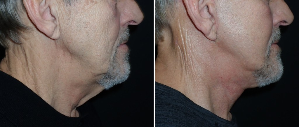 Facelifts for Men in Richmond, VA