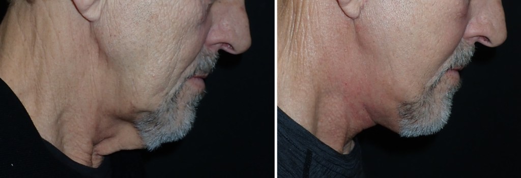 Facelifts for Men in Richmond, VA