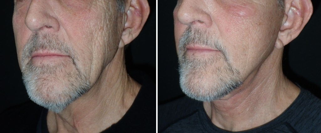 Facelifts for Men in Richmond, VA