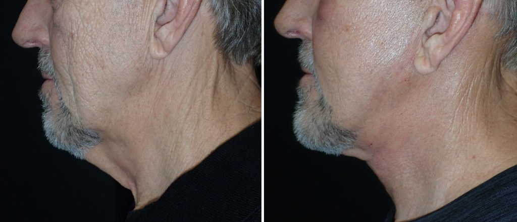 Facelifts for Men in Richmond, VA