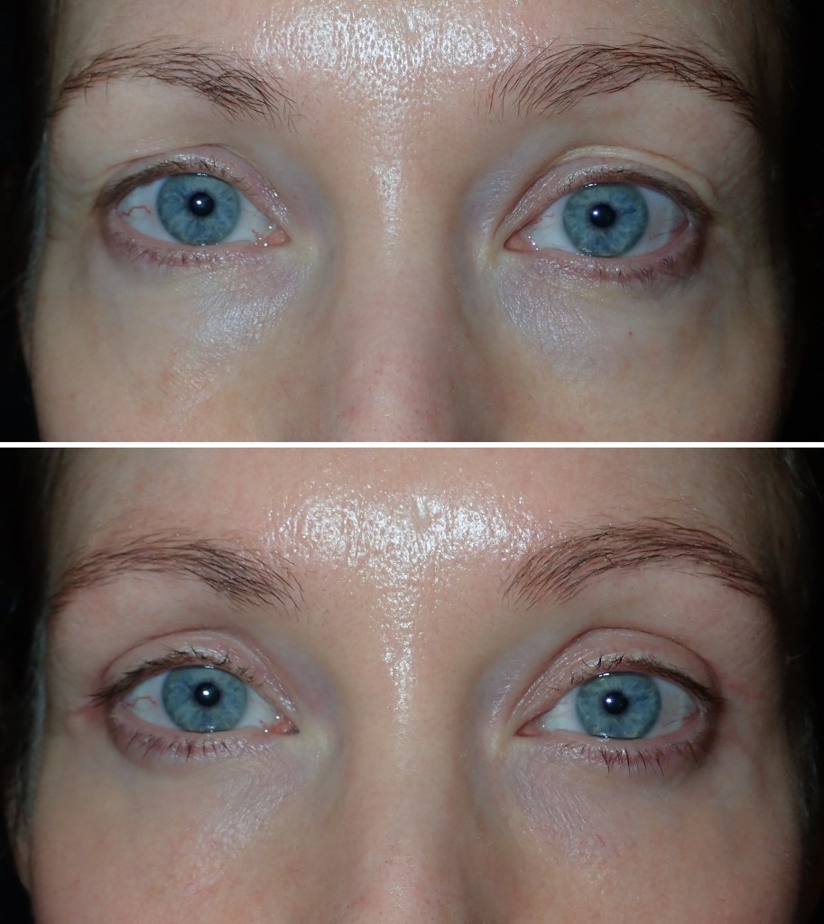 before and after eyelid surgery