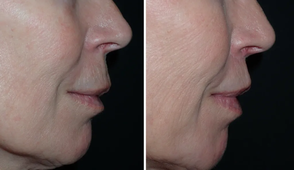facelift