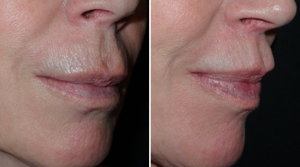 facelift
