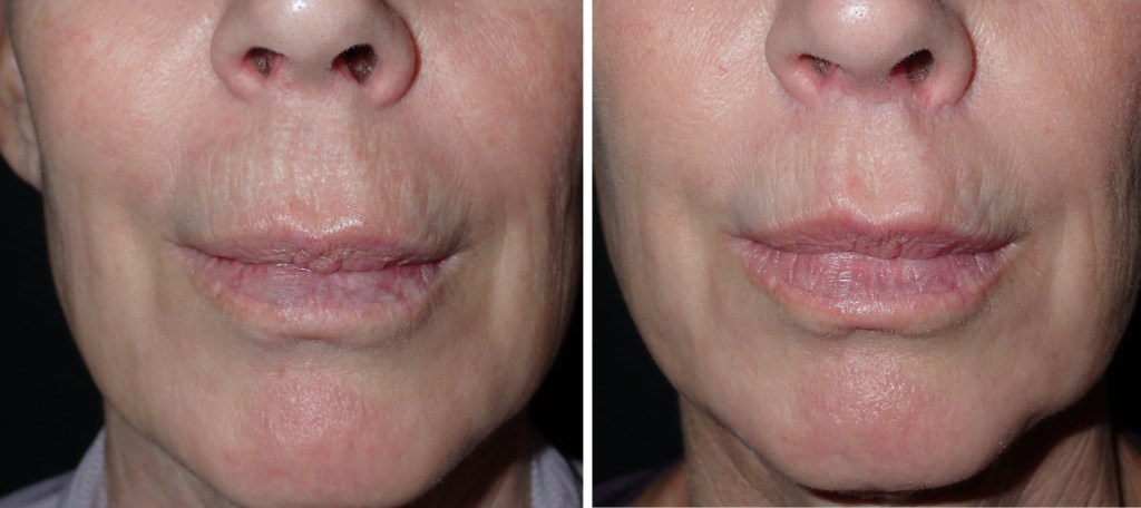 before and after lip lift