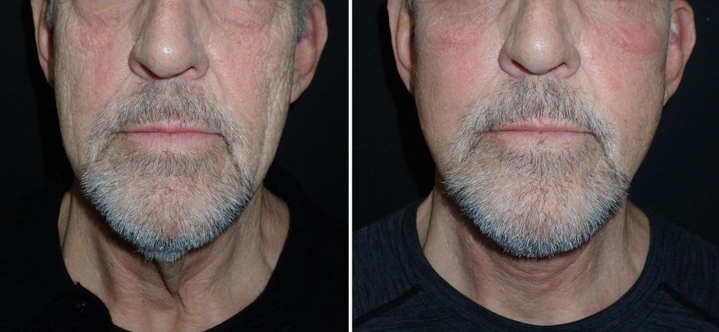 Facelifts for Men in Richmond, VA